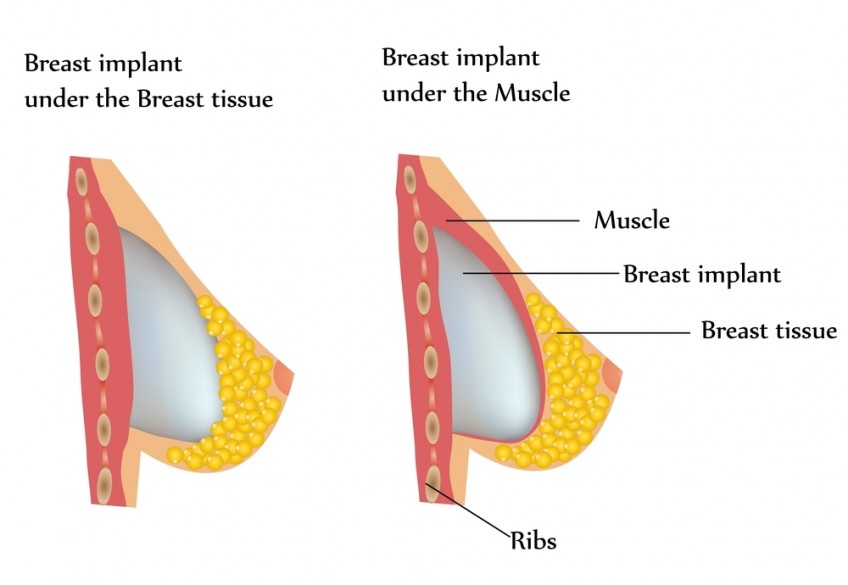 breast-implant-placement (1)